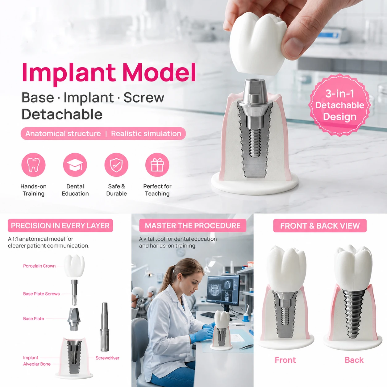 Implant Model Dental Detachable with Abutment & Screw for Dental Education, Patient Communication Clinic Display and Teaching