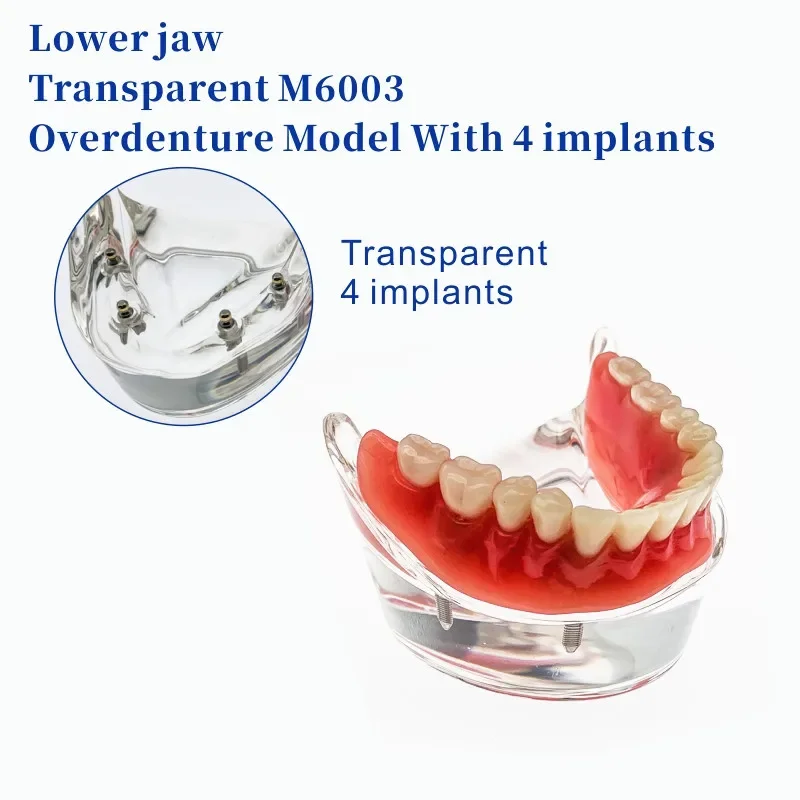 Lower jaw Dental Implant Teeth Model Removable Interior Mandibular Demo Overdenture With Implants for Tooth Teaching Study