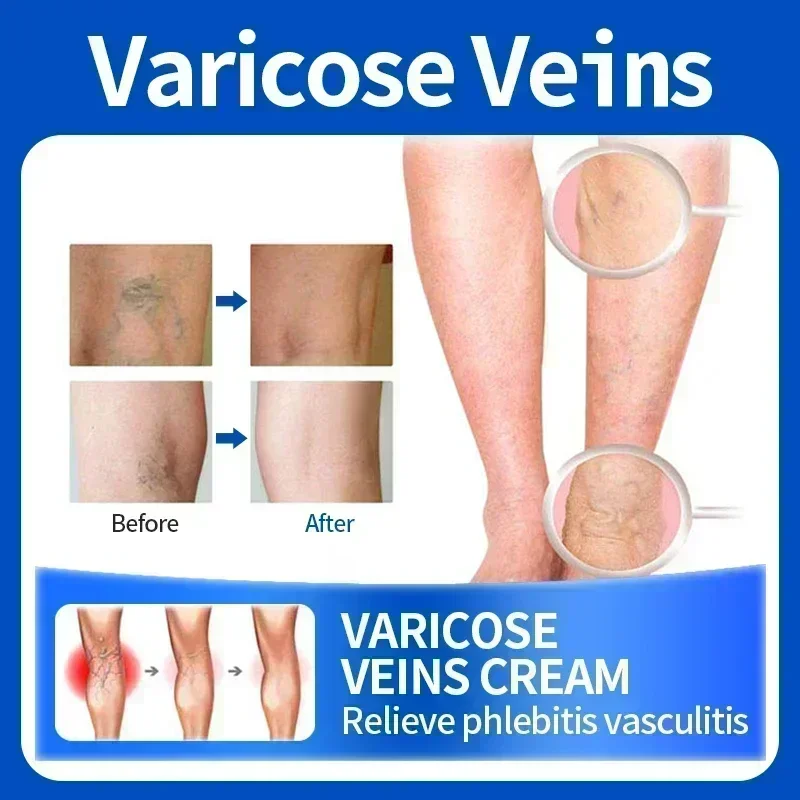 Gran oferta, nuevo ungüento para venas varicosas, elimina la Vasculitis, la flebitis para aliviar el dolor de piernas de araña, crema a base de hierbas 0903