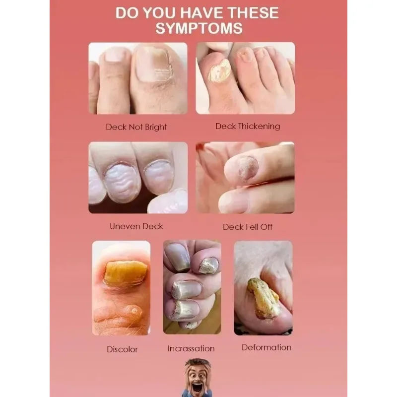 Beschermende huid Schimmel Nagel Behandeling Voetverzorging Essentie Nagel Voet Whitening Teen Nagel Schimmel Verwijdering Gel Anti Infectie Paronyc