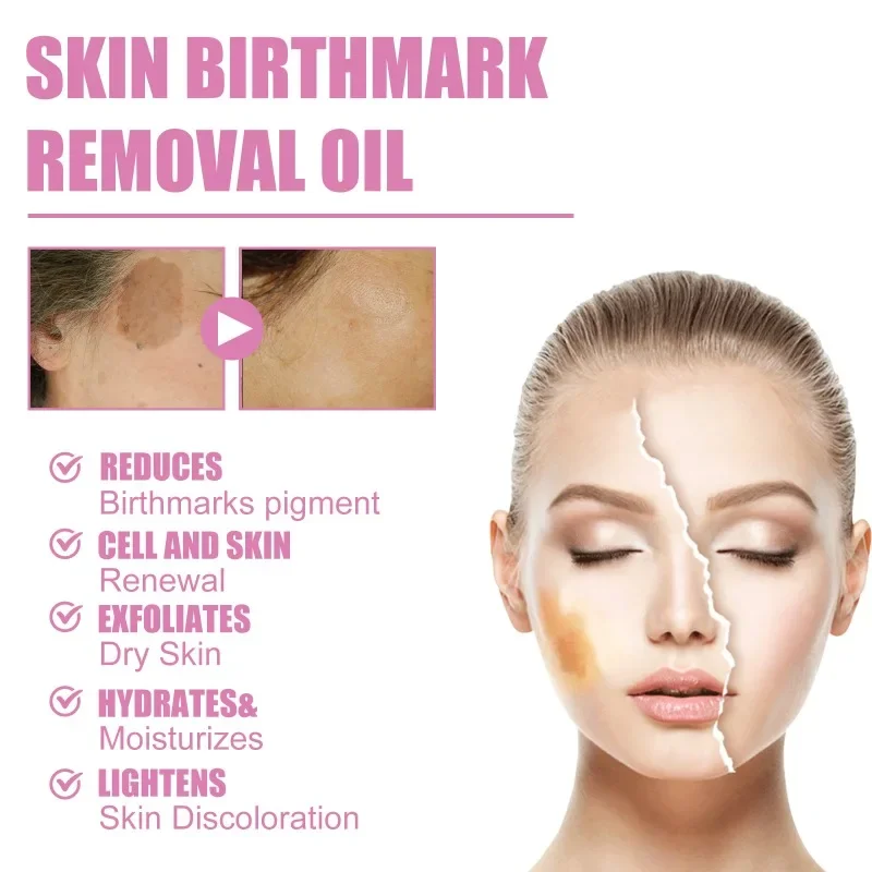 Skin Birthmark removal Serum Anti Freckle fade Pigmentation Melasma Moisturizing Whitening Brighten Face  Care Essence Oil