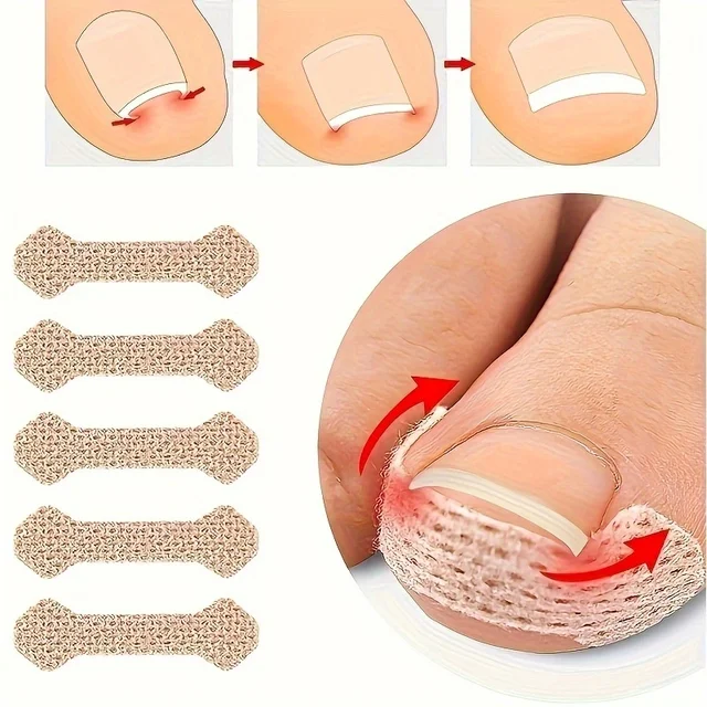 Ingrown Paronychia Toenail Corrector Strips Anti F 10szt Ingrown Paronychia Toenail Corrector Strips Anti F