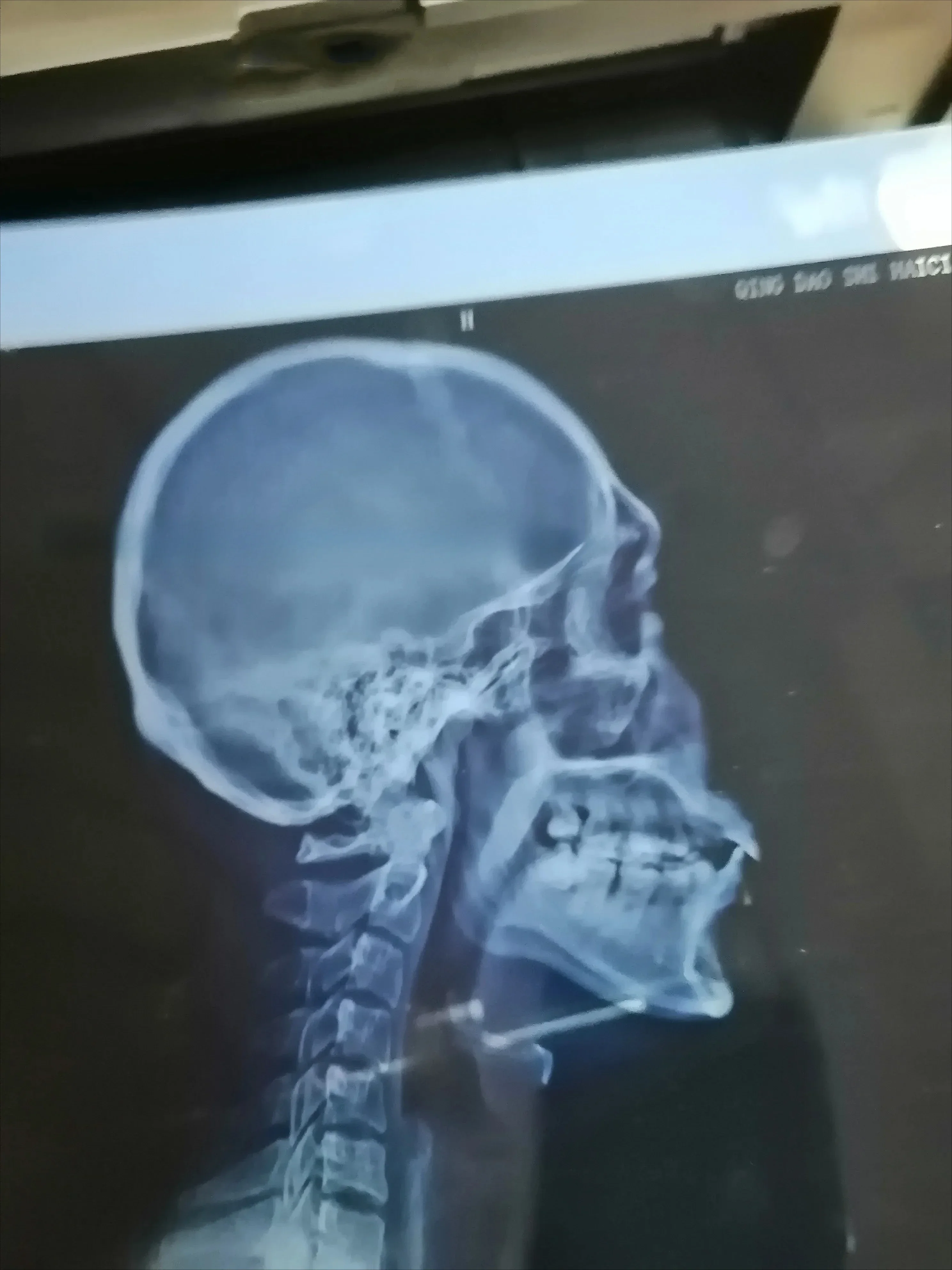 Heißer Verkauf Professionelle Inkjet Film Drucker Röntgen Film Prozessor Dicom Röntgen Drucker Für Röntgen Maschine XP02