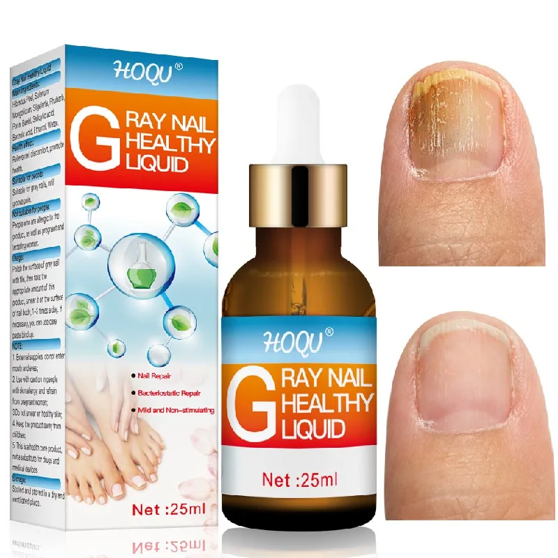 

Nail Fungal Treatment Serum Onychomycosis Paronychia Anti Infection Toe Fungus Hand Foot Removal Repair Gel Care Beauty Health