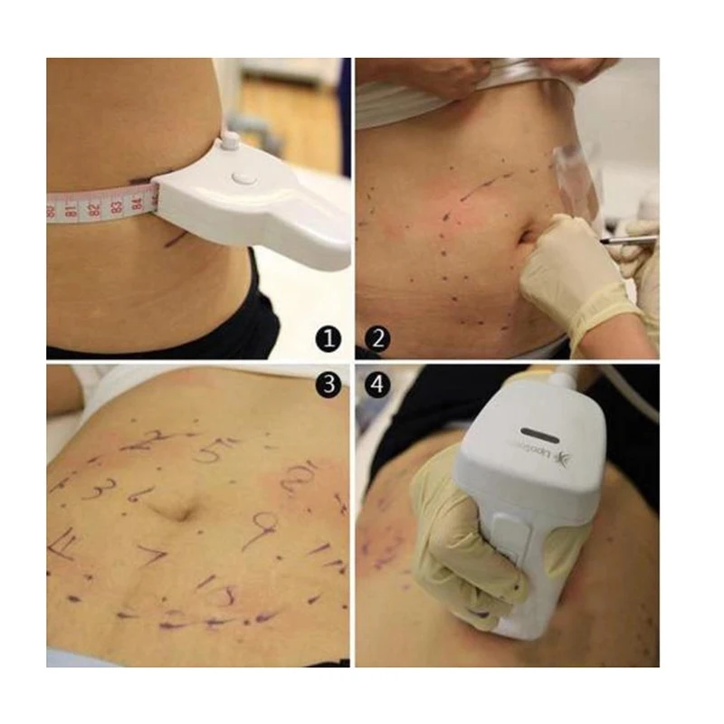 Лидер продаж, аппарат Liposonic для похудения, массажер для целлюлита, Liposonix для удаления жира и потери веса, оборудование для красоты 2025