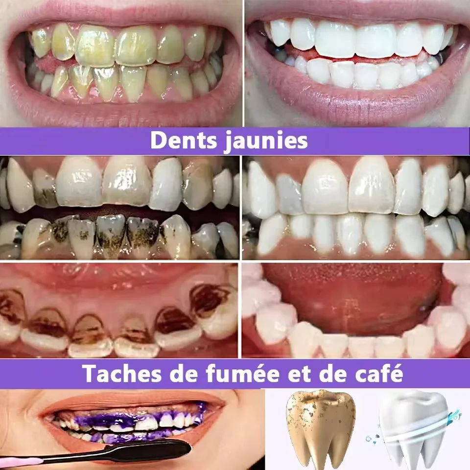 Dentifrice de blanchiment des dents, dissolvant de calcul dentaire, élimination du blanchiment, prévention de la mauvaise haleine, parodontite, soins de nettoyage dentaire