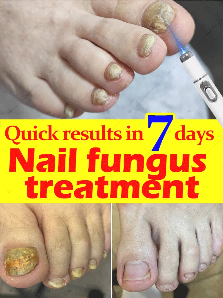 

Say goodbye to onychomycosis, no recurrence, no damage to nails.