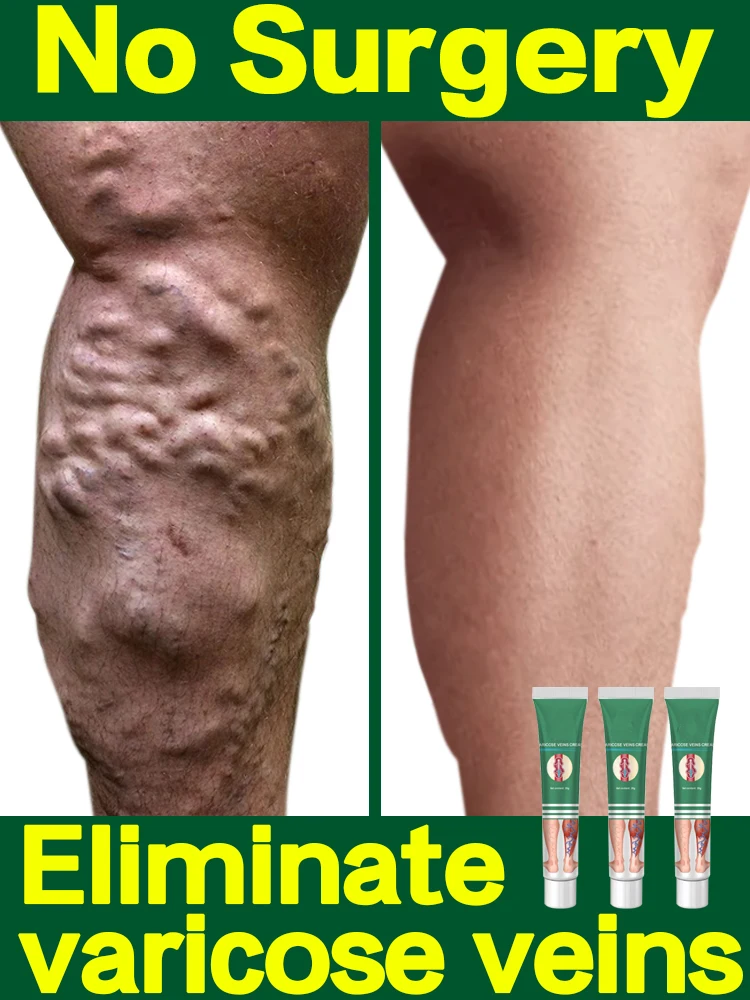 ointment for varicose veins Effective varicose vein relief cream to relieve vasculitis phlebitis spider pain treatment