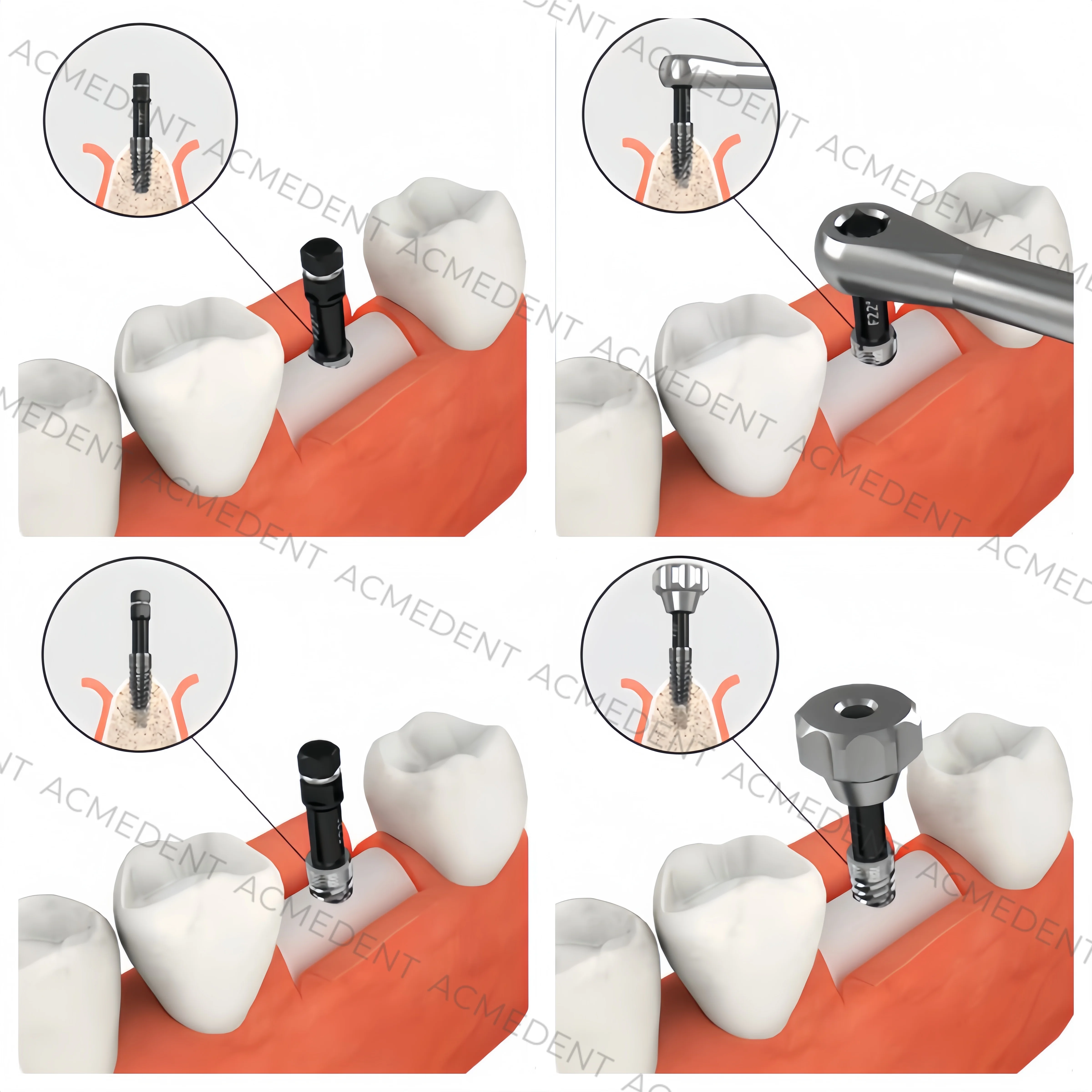 Broken Screw Extractor Remove Dental Implant Pick Up SOS Kit