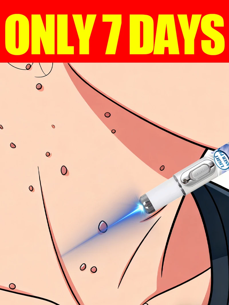 

Wart care tools, blue light pen, warts, 2025 hot sale