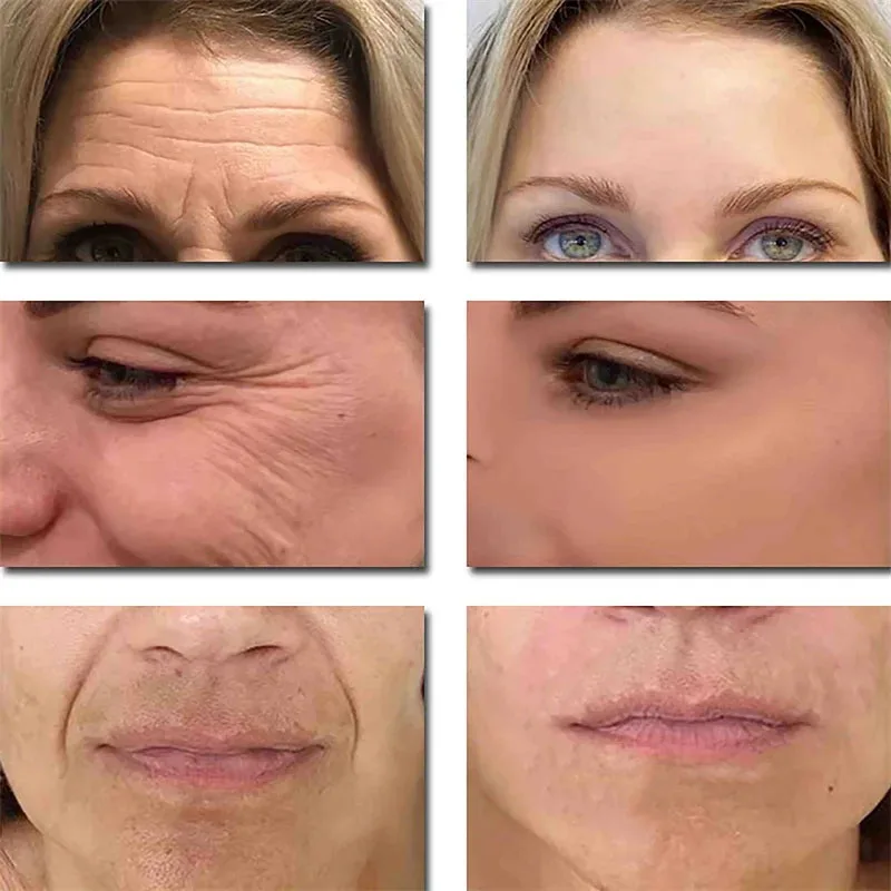 مصل الوجه لإزالة التجاعيد الفورية من الريتينول لشد البشرة والخطوط الدقيقة الكورية المضادة للتجاعيد منتجات العناية بالبشرة ﻿