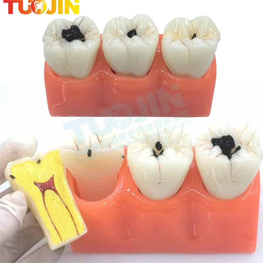 Teeth Model Caries Comparation Study Models 4Times/6times Caries model Teaching research model for dentistry students