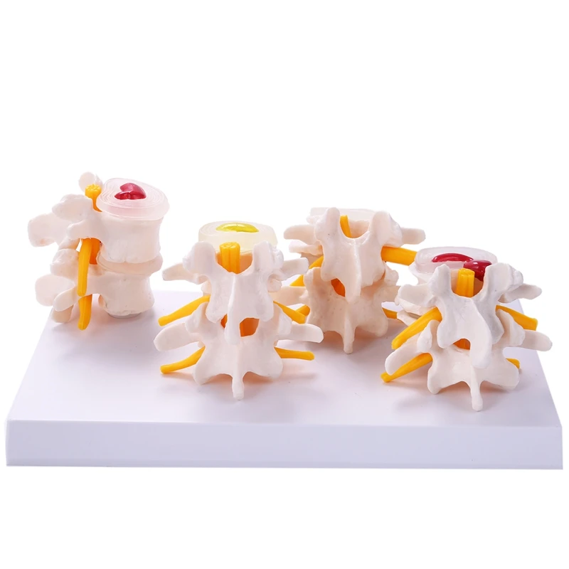 ABYC Human Anatomy Skeleton Spine 4-Stages Lumbar Vertebral Model Brain Skull Traumatic Teaching Supplies