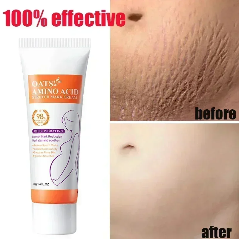 ²⁰²⁵ Removes Stretch Mark Cream To Remove Postpartum Obesity Pregnant Women Repair Anti-Aging Winkles Firming Body Cream Skin Ca