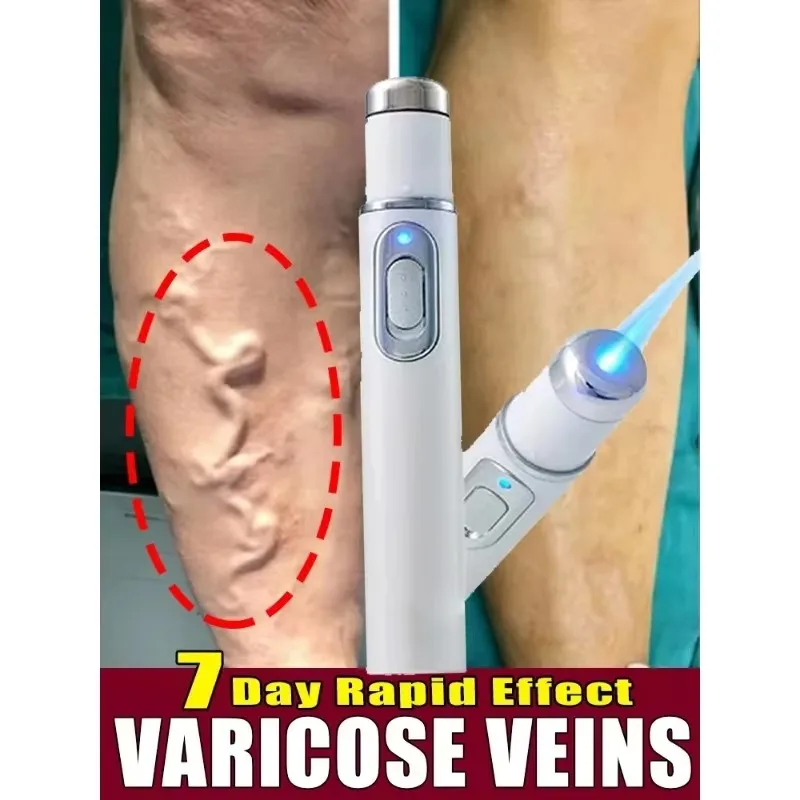 

Laser Therapy Varicose Veins Treatment Remove Varicose Vein Effective Relieve Leg Dilated Vasculitis Improving Blood Circulation