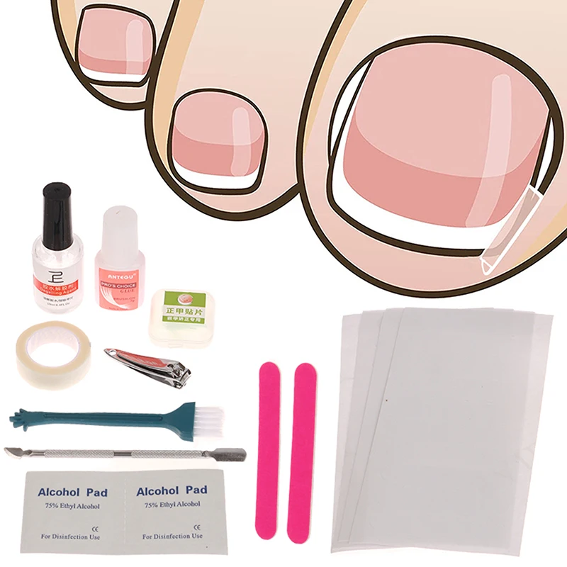 Ferramenta de correção de unhas encravadas, tratamento de unhas encravadas, adesivo elástico, clipe de alisamento, ferramenta de pedicure