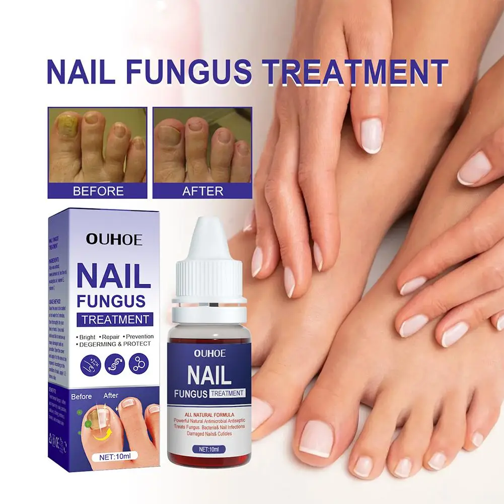 Anti Infecção Unhas Tratamento Fungoso, Pés Cuidados Essence, Onicomicose, Paroníquia, Fungus Toe Remoção Serum, R V5V8, 1Pc