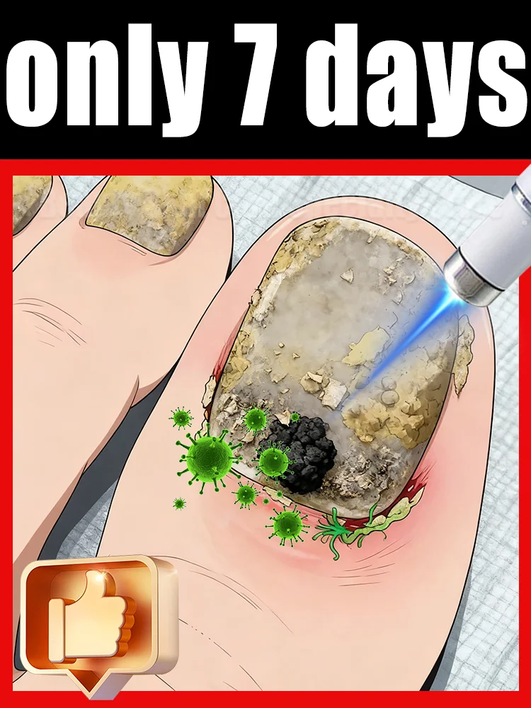 

The fifth generation of champagne-colored nail laser pen helps remove nail fungus, colorless and long-lasting sterilization