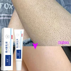 Body Whitening Cream Keratosis Pilaris Treatment Bumpy Rough Chicken Follicle Skin Repair Strawberry Legs Removal Dry Skin Care