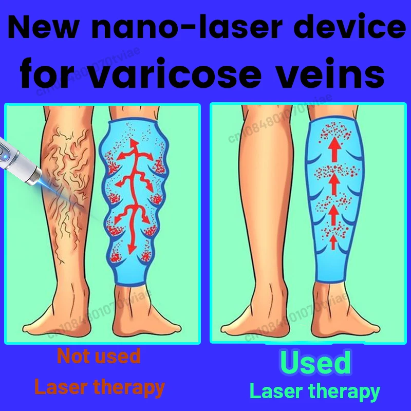 

Специально разработан для варикозного расширения вен, десяти лет исследований и разработки, предназначен для решения варикозного расширения вен.