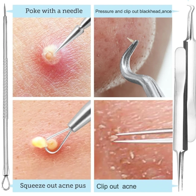 Stainless Steel Blackhead Remover Comedone Squeezer Set Blackhead Extractions Tool Pimple Squeezing Tool for Face Clean