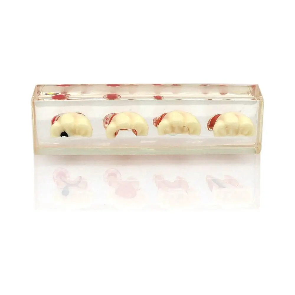 

Модель зубов, эндодонтическая обработка, 4-ступенчатая прозрачная акриловая основа, обучающая демонстрационная демонстрация для стоматолога M4018