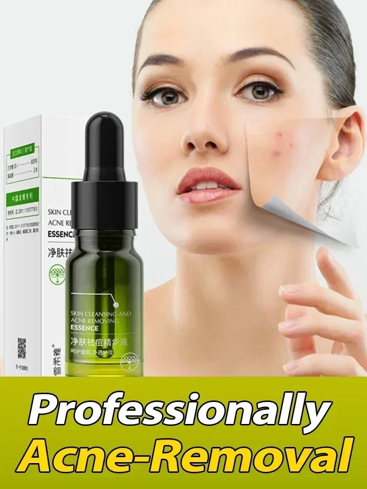 Effective Acne Removal Comfortable Acne-removing Liquid Improve Acne Convenient Facial Repair Solution Skin Care Products Gentle