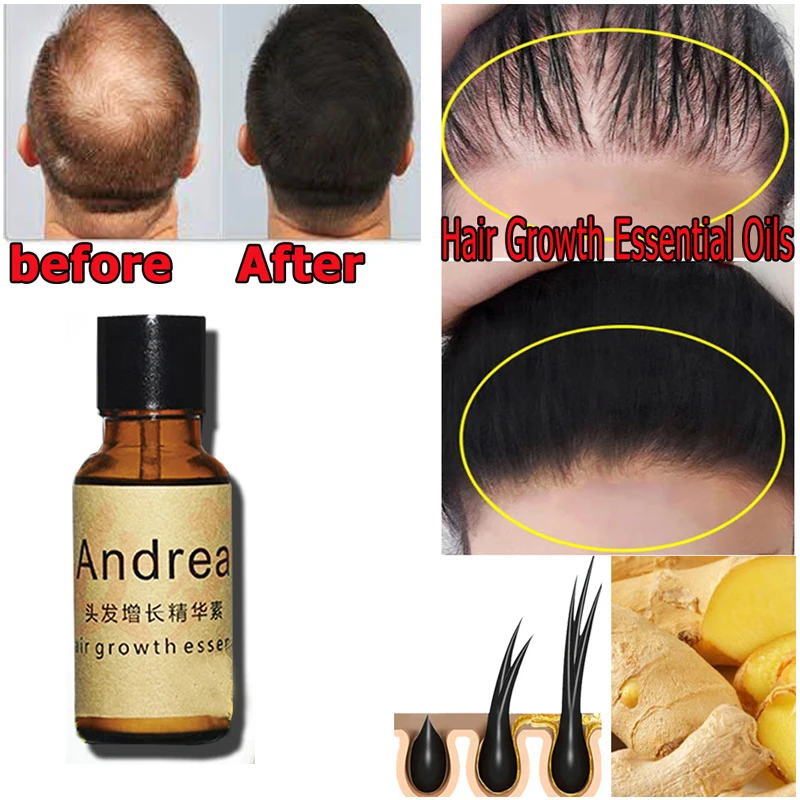 2/5/10Pcs Andrea Hair Growth Serum Oil Herbal Keratin Fast Hair Growth Alopecia Loss Liquid Ginger Sunburst Yuda Pilatory Oil