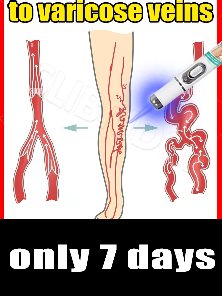 

2025 Leg care tools Vein blue light pen solve varicose veins,Say bye spider leg, varicose veins for Men Women All People
