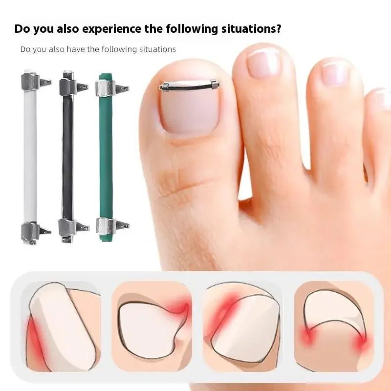 Ingrown Toenail Pedicure Tool Embed Toe Nail Care Straightening Correction Clip Curved Clamp Toenails Correction Tool For Toes