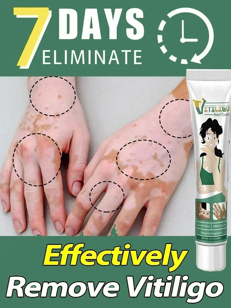 

Improve Skin Pigmentation and Reduce White Spots Vitiligo Treatment Cream