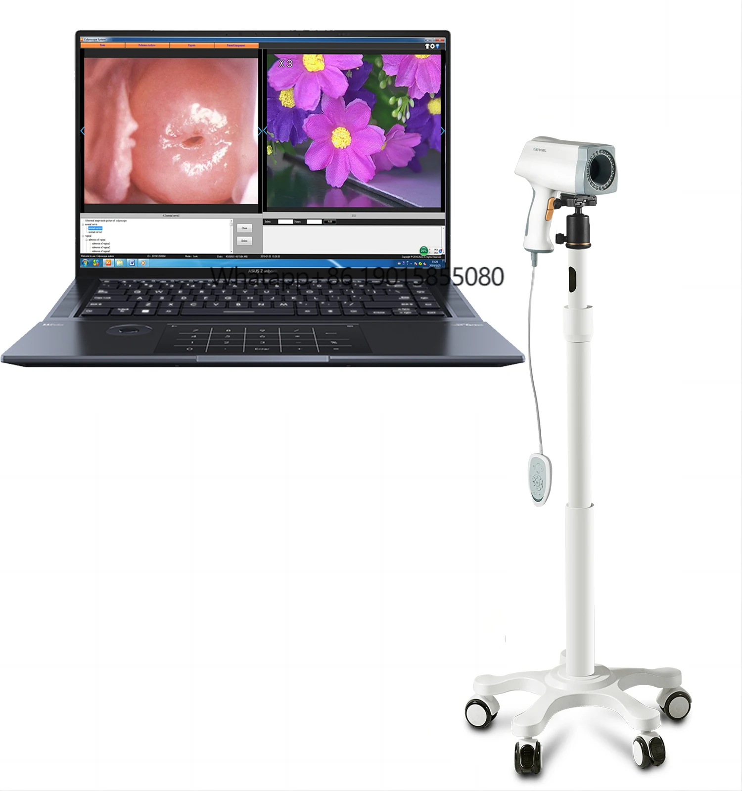 Wholesale Laptop Digital for Cervical Cancer Screening Gynecology Equipment