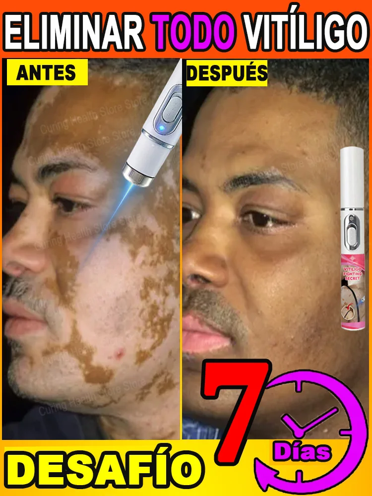 laser vitiligo