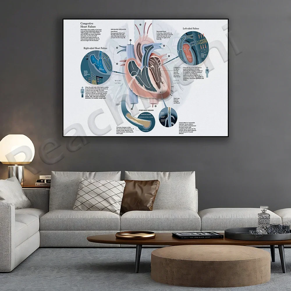 Congestive Heart Failure Horizontal Poster, Heart Failure Awareness Wall Art, Human Heart Medical Wall Decor, Cardiologist Gift