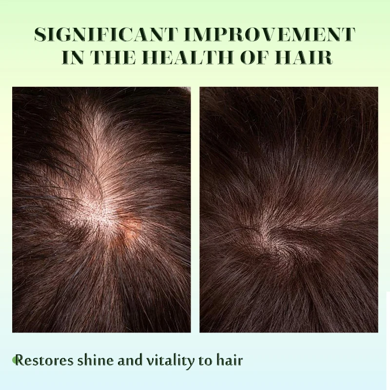 Sevich Rosemary Hair Growth Oil Microneedle Roller Set Anti Hair Loss Scalp Treatment Serum Hair Care Essential Oil