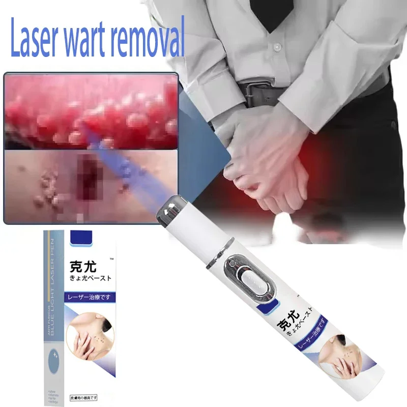 

Лазерная ручка для глубокой стерилизации для лечения плоских бородавок, кондилома, алюминату и различных бородавок. Физическое безболезненное удаление бородавок.