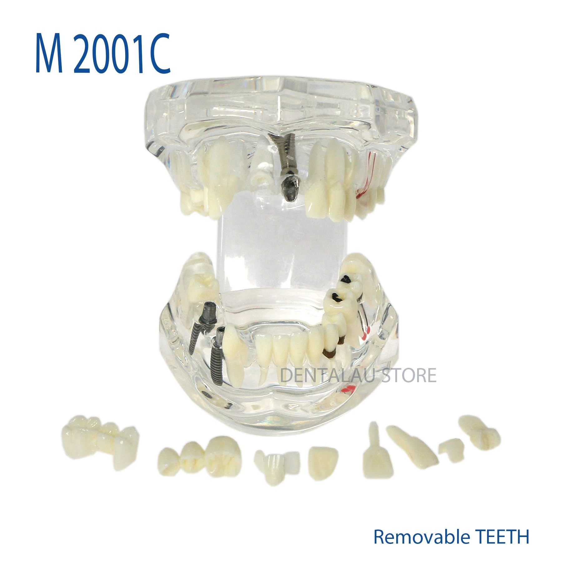 

Dental Implant Pathological Teaching Model M2001C Transparent Removable Tooth