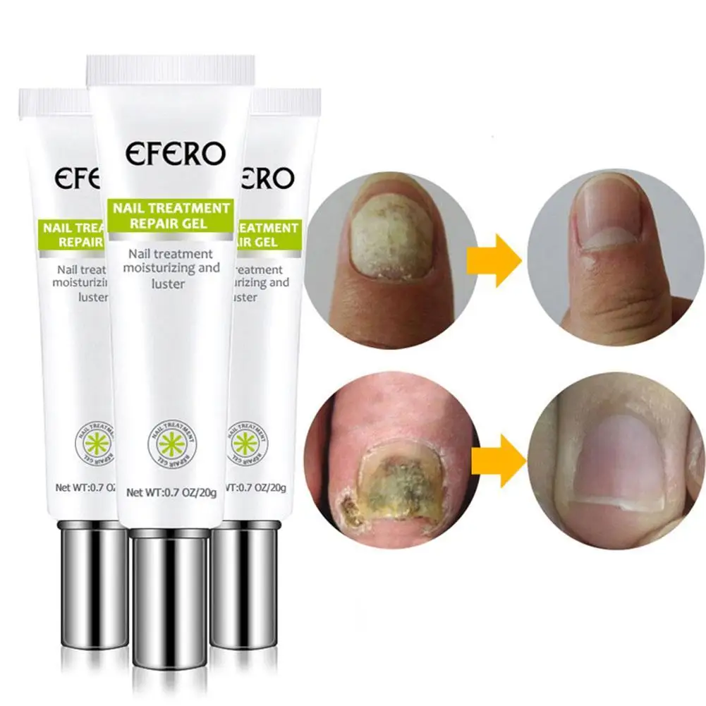 Fungal Nail Treatment Gel Foot Nail Fungus Removal Gel Anti Nails Foot Repair Gel Care Onychomycosis Infection Paronychia Y0M8