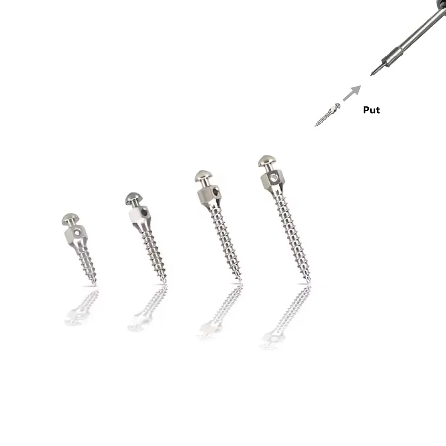 5 stuks multi-size titanium orthodontische bevestigingsschroeven |   Beschikbare maten: 1,4 mm, 1,6 mm & 1,8 mm. Tandheelkundige onderdelen.