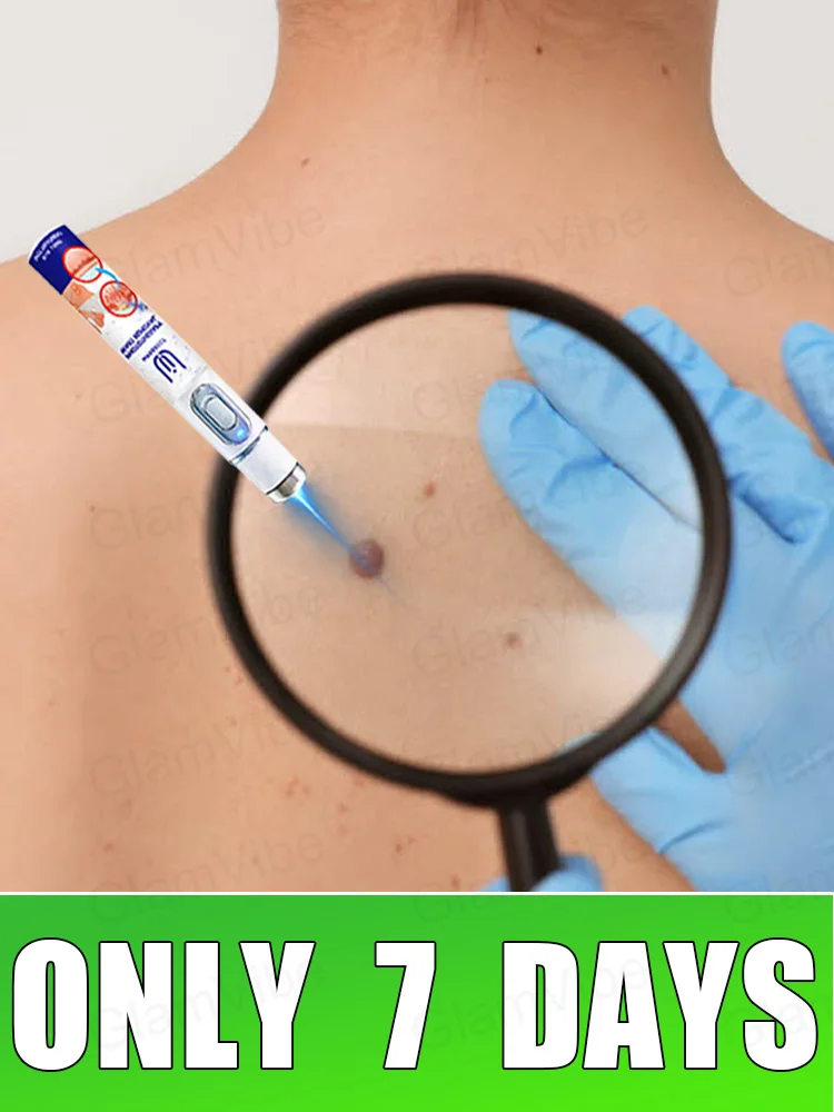 

2025 New Upgrade Blue Laser Solve Wart Tool