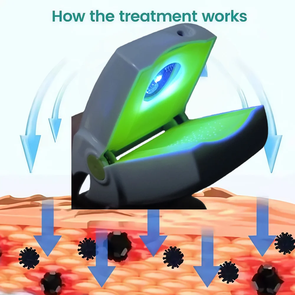 

Fast Nail Repair Laser Device Upgrade for Onychomycosis Care Toenail Fingernail Fungus Aid Painless Foot Treatment