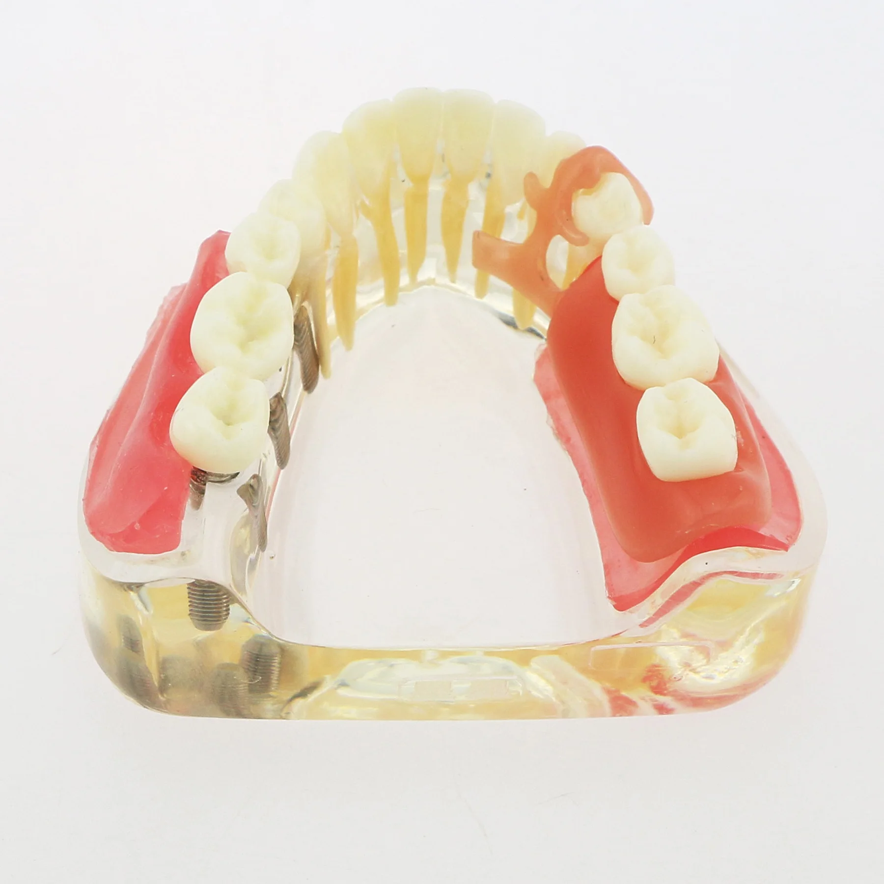 Implant dentystyczny Model zębów Typodont Overdenture 3 implanty M6006 Demo leczenia odtworzenia dolnego mostu studiujące nauczanie