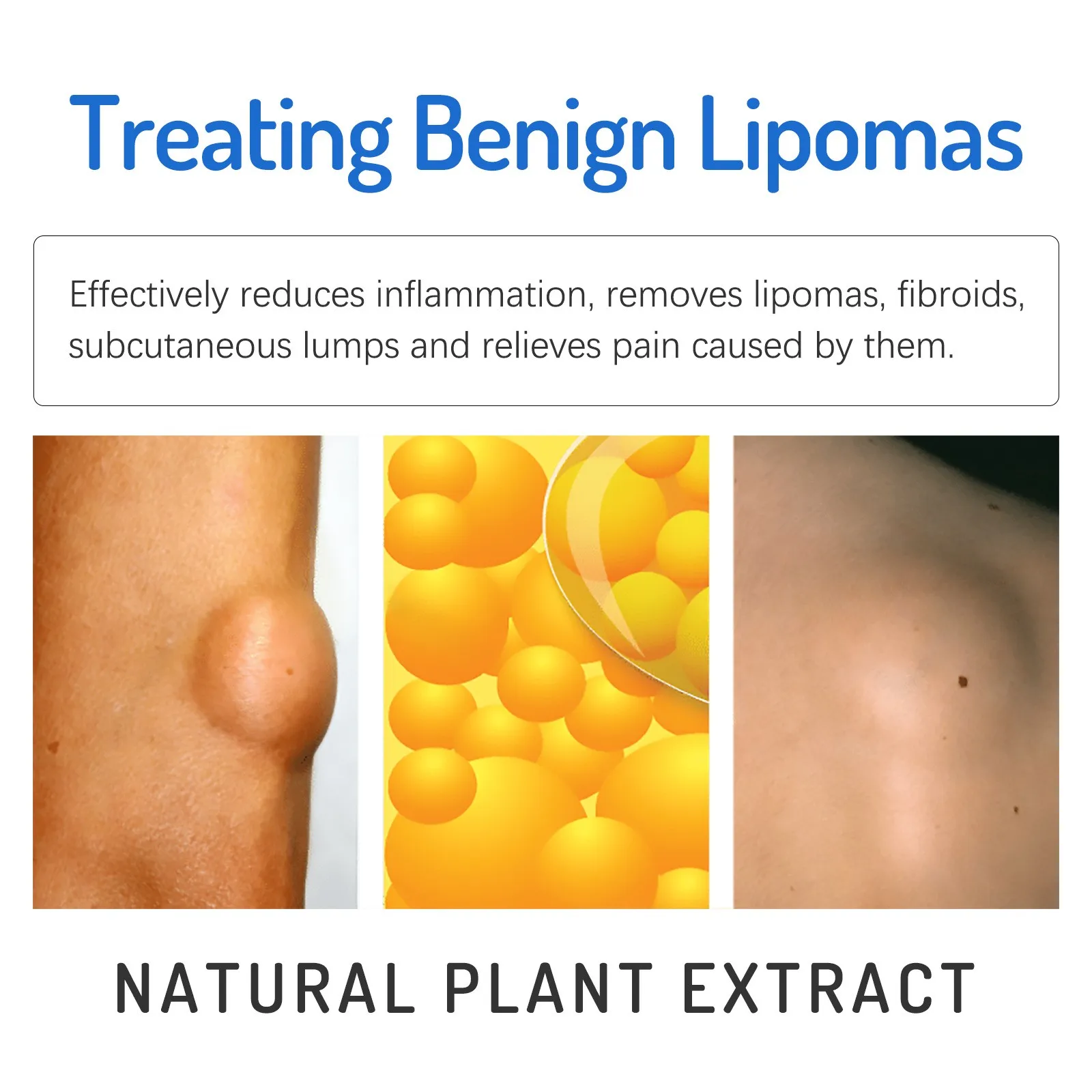 Lipoma Ointment, Lipoma Removal Paste, Natural Herbal Lipoma Lump Removal Paste, Fat Tumor Cream Natural Herbal Extracts