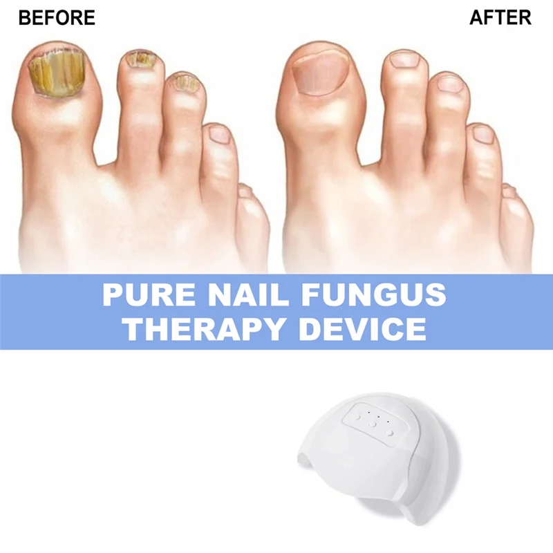 【SURPRISE】Fungal For Nail Treatment Device Lasers For Nail Fungus Onychomycosis Cleaning Foot Repair Fungi Removal Anti Mushroom