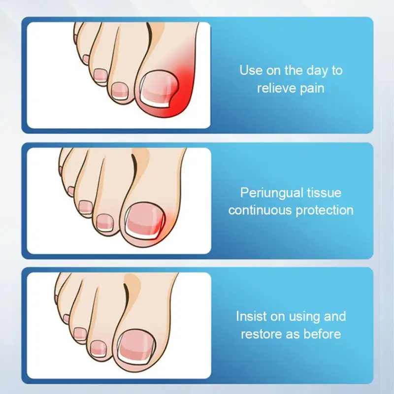 Dispositivo de reparación rápida de uñas, 1 piezas, hongos en las uñas, onicomicosis, elimina los hongos en las uñas de los pies