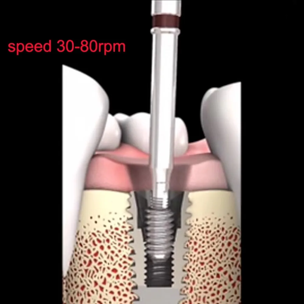 Uchwyt do implantu dentystycznego Złamane złamane śruby Usuwanie urządzeń do implantu Śruby do implantu Narzędzie do burów