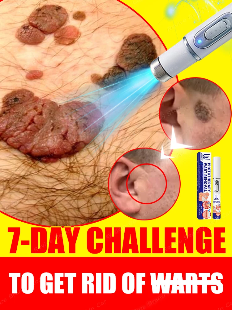 

Say Goodbye To Skin Tags