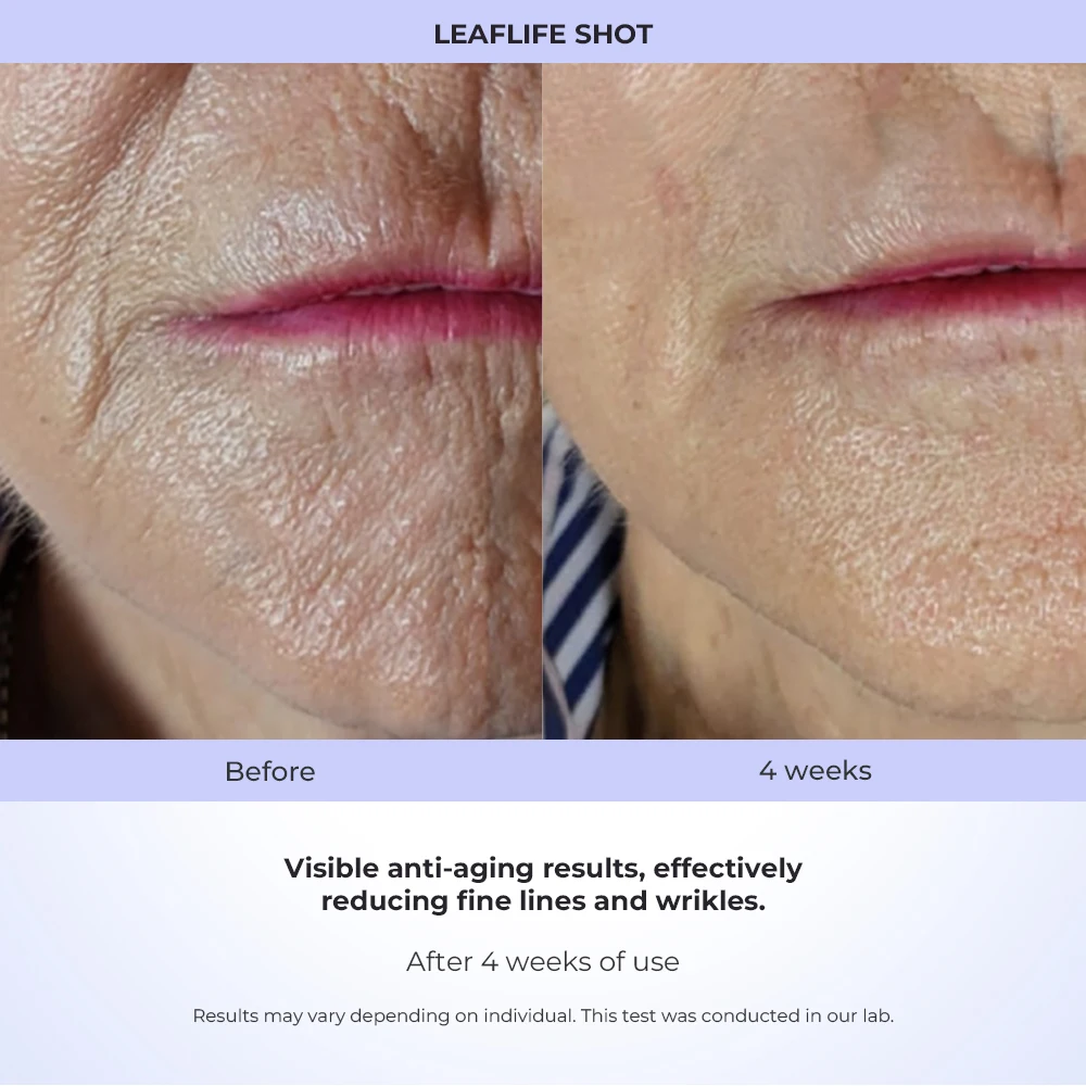 โลก # ปากกาพลาสมาเย็นสำหรับยกกระชับใบหน้าและลำคอ 1 เครื่อง สำหรับใช้ในร้านเสริมสวย/คลินิก ยี่ห้อ Leaflife อุปกรณ์ความงามนวัตกรรมใหม่สำหรับใช้ในบ้าน ช่วยลดเลือนริ้วรอย