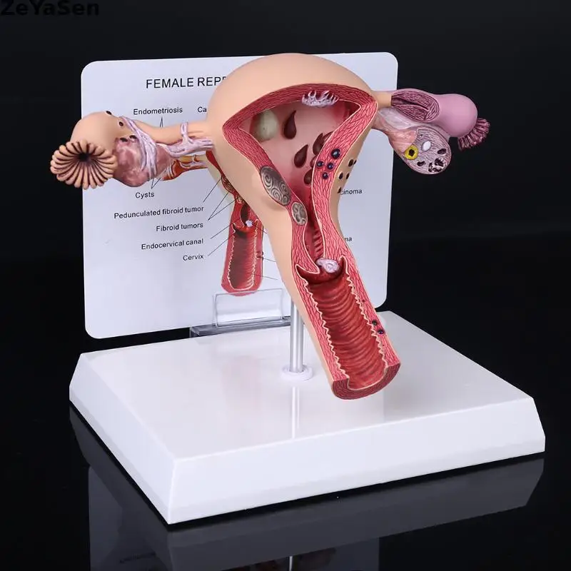 Medical props model Human Female Pathological Uterus Ovary Model Anatomical Disease Pathology Medical Lesion ForBiology Teaching