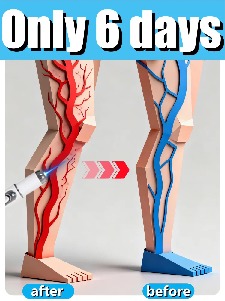 2025 أدوات العناية بالساق: أدوات مريحة للأوردة غير الطبيعية - قل وداعًا للبشرة المرتفعة #1